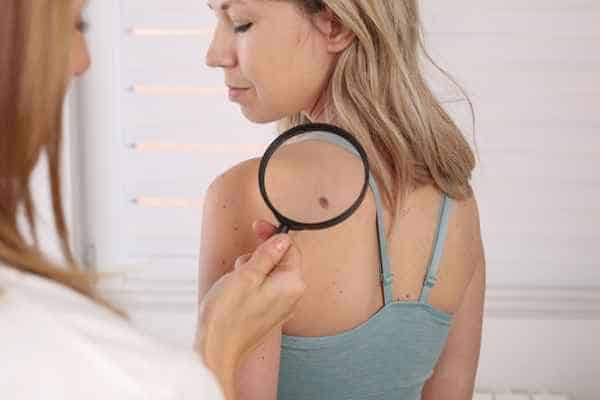 What Are Traditional Skin Lesion Removal Methods Ayr?