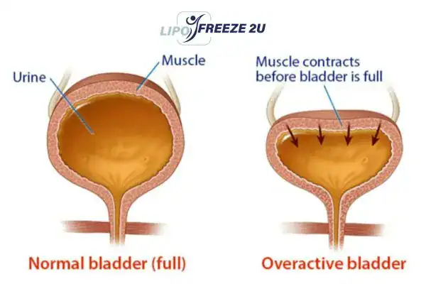 diagram of overactive bladder treatment Ayr
