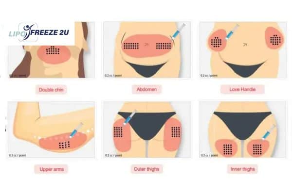 Benefits of Choosing Aqualyx for Fat Reduction Ayr