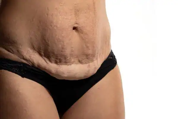loose skin after weight loss injections Ayr
