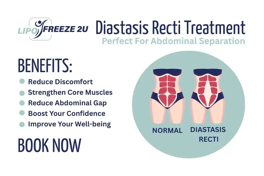 Benefits of body toning treatment Ayr for Diastasis recti