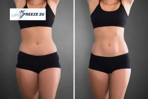 How Can LIPO FREEZE 2U Support Your Post-Pregnancy Body Recovery Ayr?