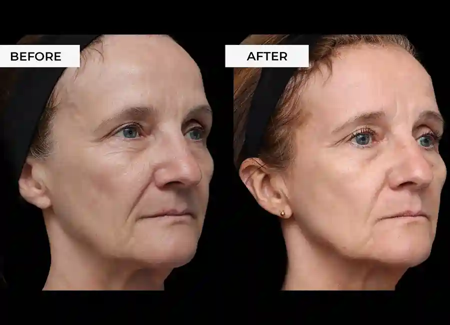 How Many RF Microneedling Sessions Will You Need to See a Difference Ayr?