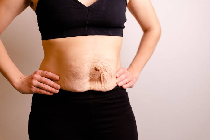 Is Surgery Really the Only Way to Repair Diastasis Recti Ayr?