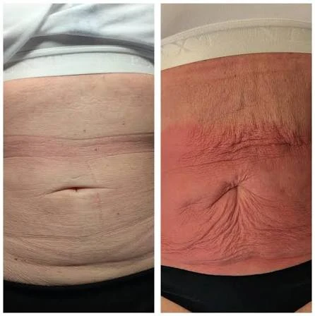 How Does RF Microneedling Improve Crepey, Thin and Uneven Skin Texture Ayr?
