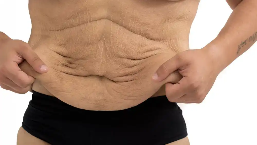 Why Does Weight Loss Medication Leave Some People With Loose or Sagging Skin Ayr?